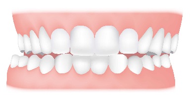 Crossbite - A crossbite is where your upper teeth bite inside your lower teeth. In can happen on one or both sides of your jaw and it can affect your front or back teeth.