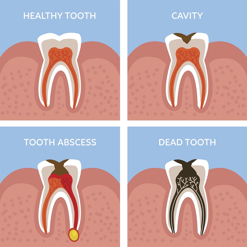 Can a Dead Tooth be Saved?