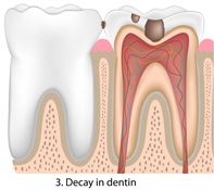 Decay in Dentin