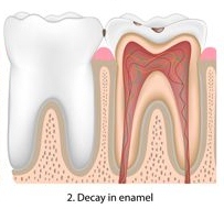 Decay in Enamel