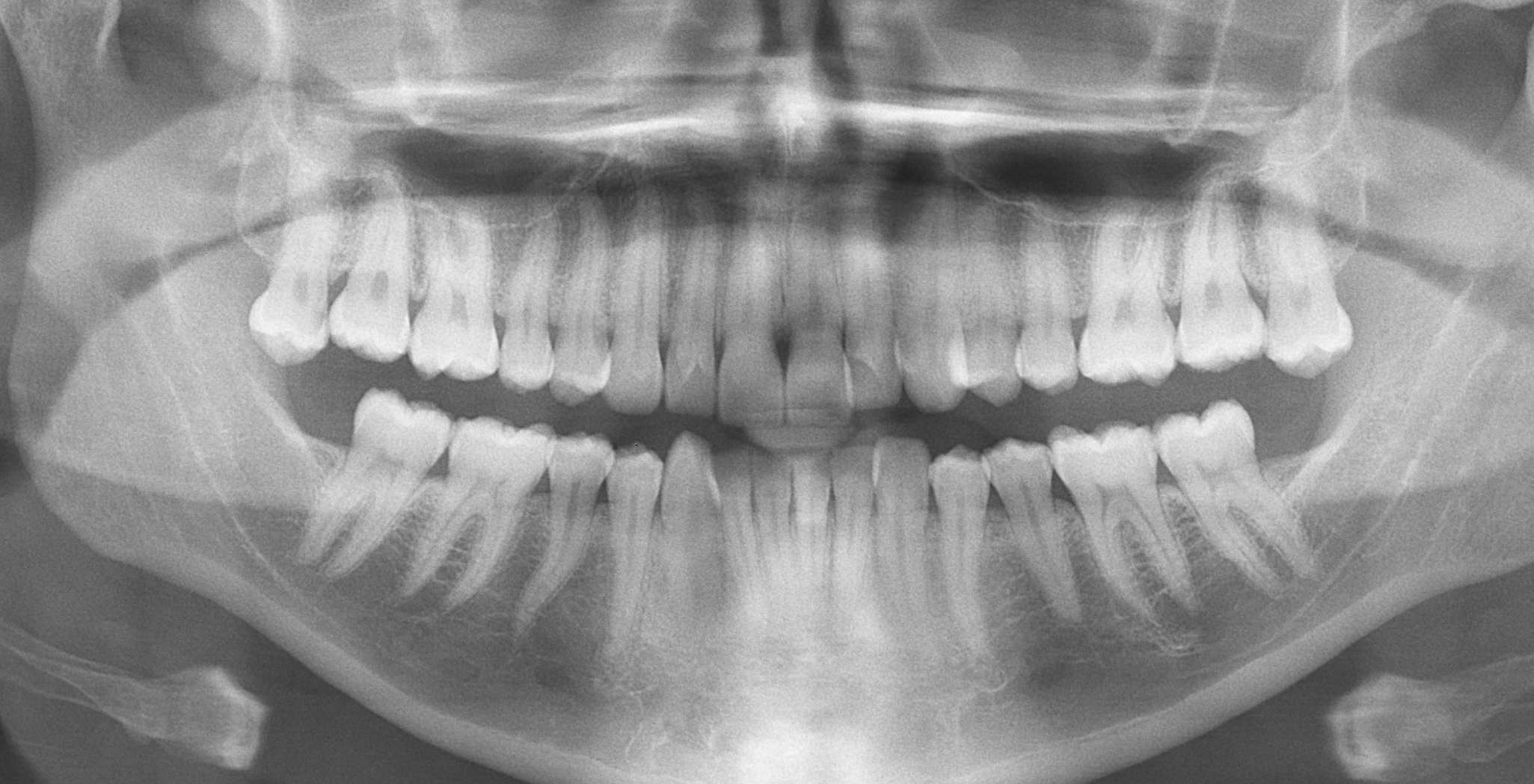 x ray children teeth