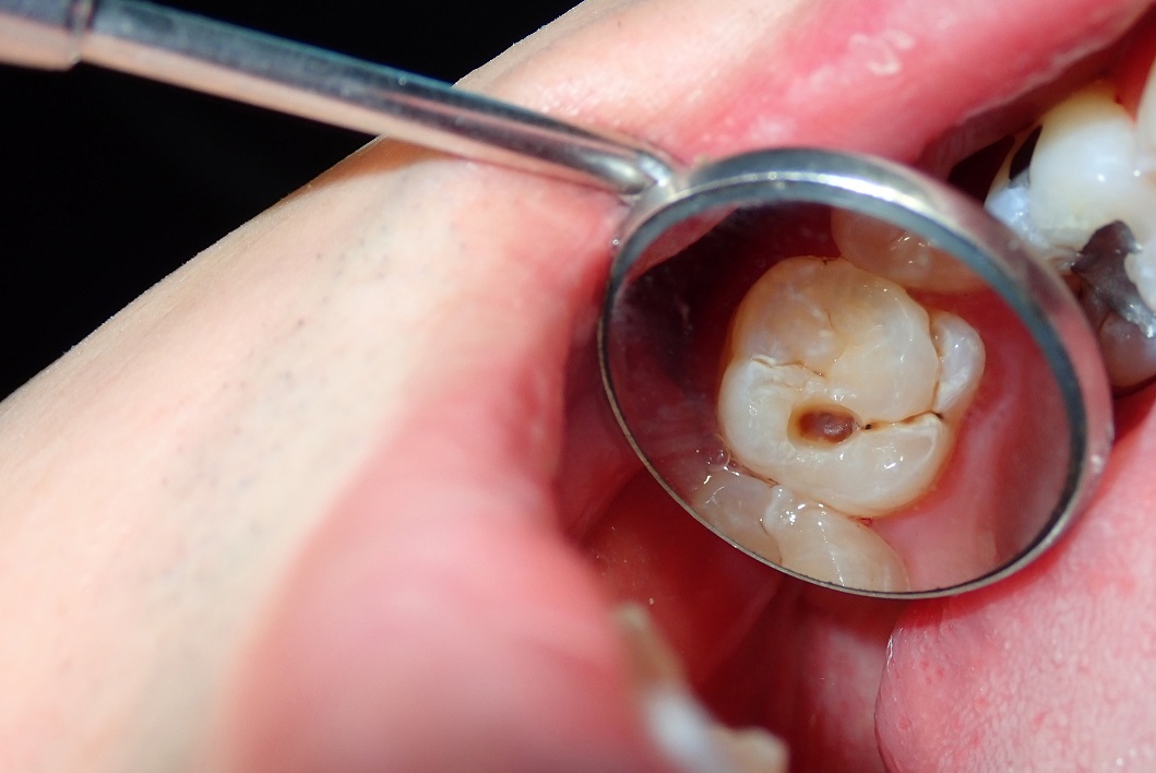 Favero Family Dental | Choices For Fixing Cavities