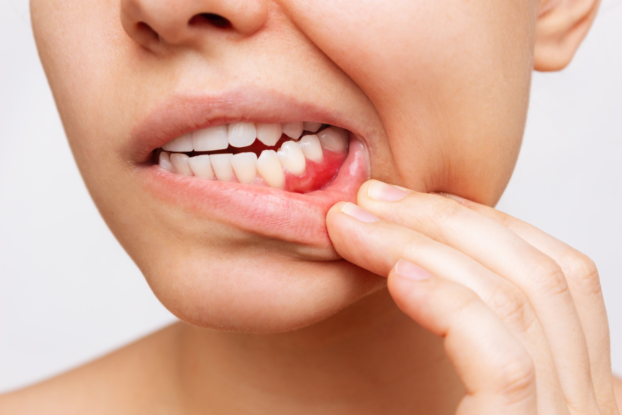 Gingivitis Symptoms You Shouldn’t Ignore