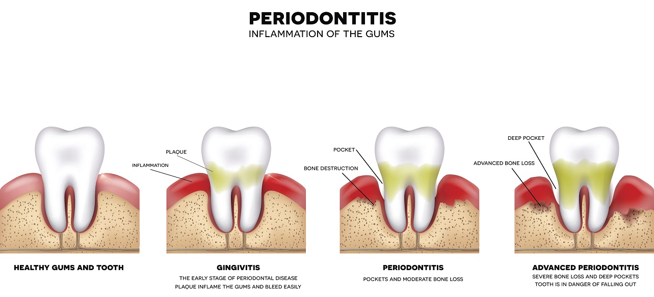 Dangers of Gum Disease