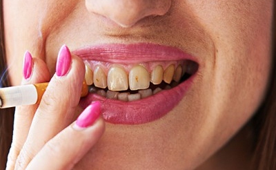 Don’t Light Up: Smoking Increases the Risk of Dental Implant Failure