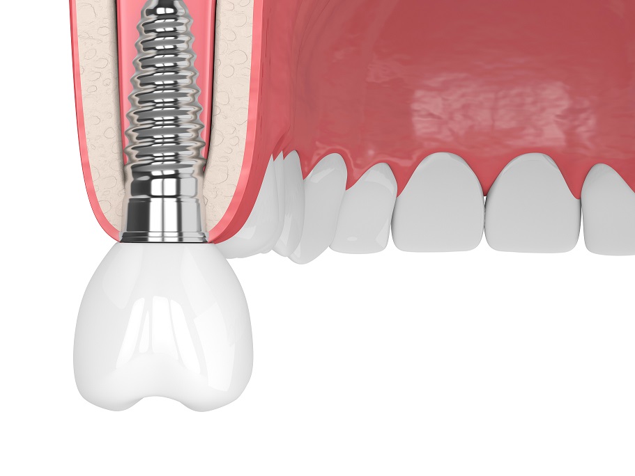 Replacing Missing or Lost Teeth