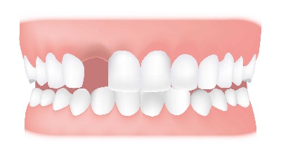Missing Tooth - Missing teeth can occur as a result of teeth not developing properly or through trauma.