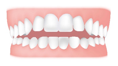 Open Bite - An open bite is where the front teeth don’t overlap the lower teeth. An open bite affecting the front teeth is known as an anterior open bite.
