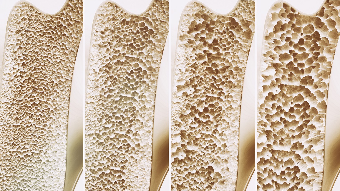 Osteoporosis and Oral Health