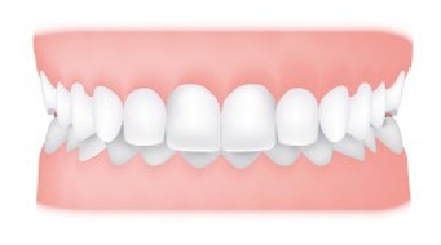 Overbite - While there should be some overlap of your lower front teeth, in some cases an increased overbite can cause your front teeth to bite down onto your gums.