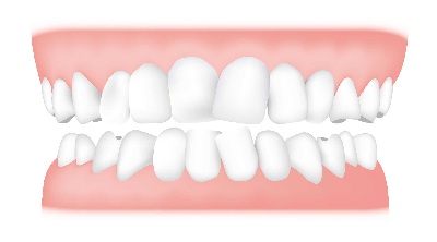 Overcrowding - Overcrowding is very common and it’s often caused by a lack of space, resulting in teeth that are crooked and overlap.
