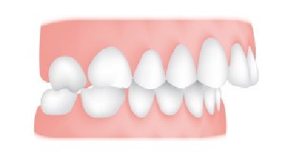 Overjet - An overjet is where your top teeth extend past your bottom teeth horizontally (not to be confused with an overbite). Protruding teeth can risk damage and cause problems with eating and speech.