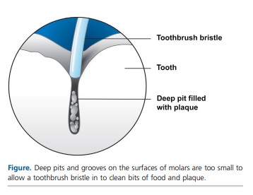 Reducing the Risk of Cavities with Sealants