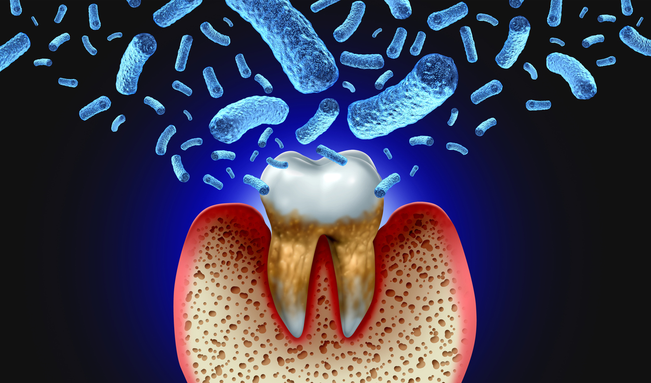 Dental Sepsis