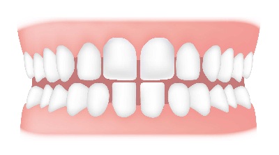 Spacing - Spacing can occur between two or more teeth. Some of the causes can include missing teeth, small teeth, tongue thrusting and thumb sucking.