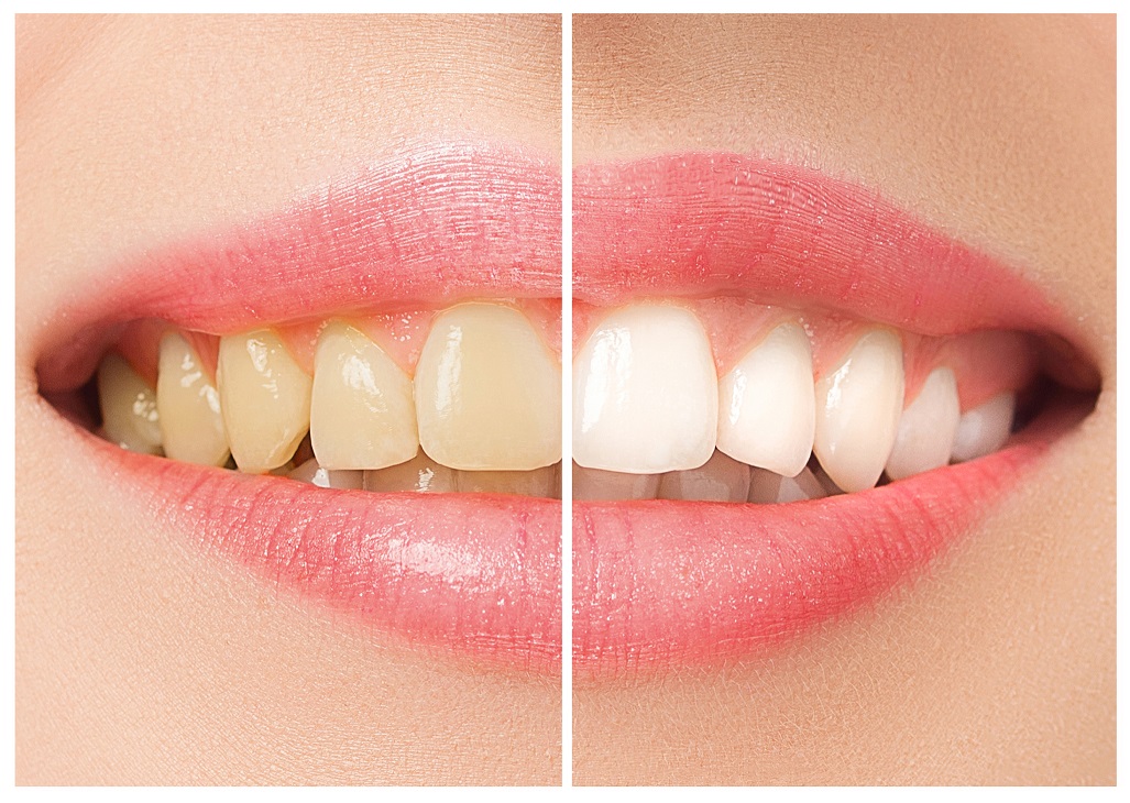 Teeth Whitening