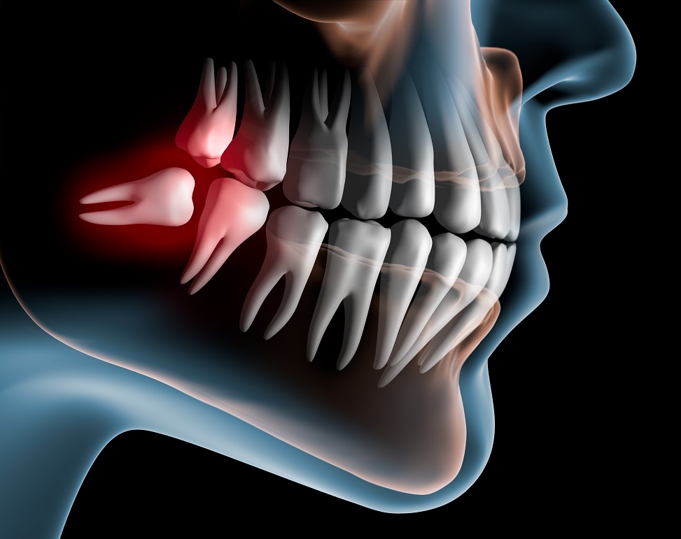 Wisdom Teeth Extractions