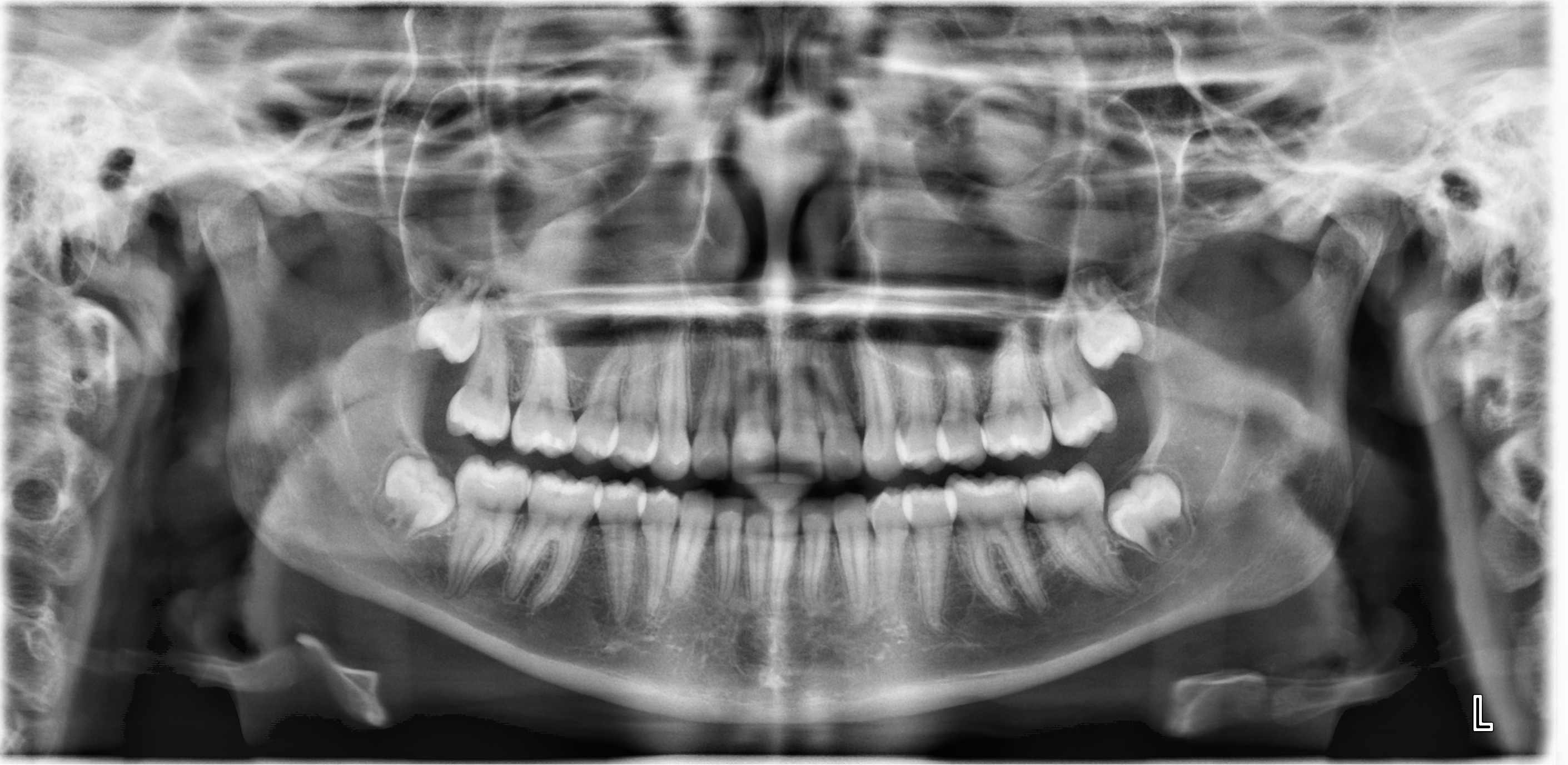 Lead Aprons and Thyroid Collars No Longer Needed for Dental X-rays