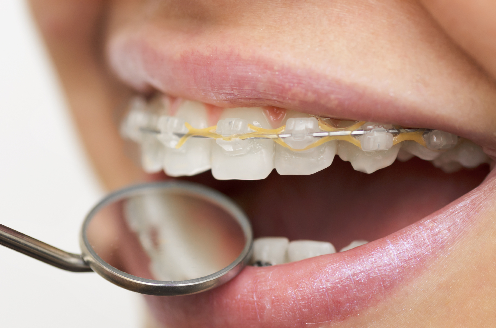 All You Need to Know About Braces – Adjustments
